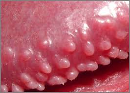 pearly-penile-papules-enlarged.jpg