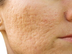 Efectos del acne
