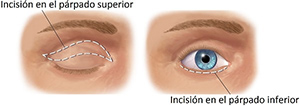 Cirugía de la mirada