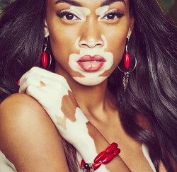 Modelo con vitiligo