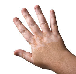 Qué es el vitiligo