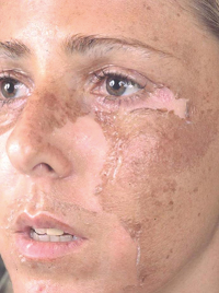 Humano Agua con gas Preguntarse Cómo quitar manchas de la cara con peelings químicos.