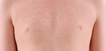 urticaria