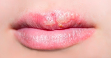 herpes en el labio